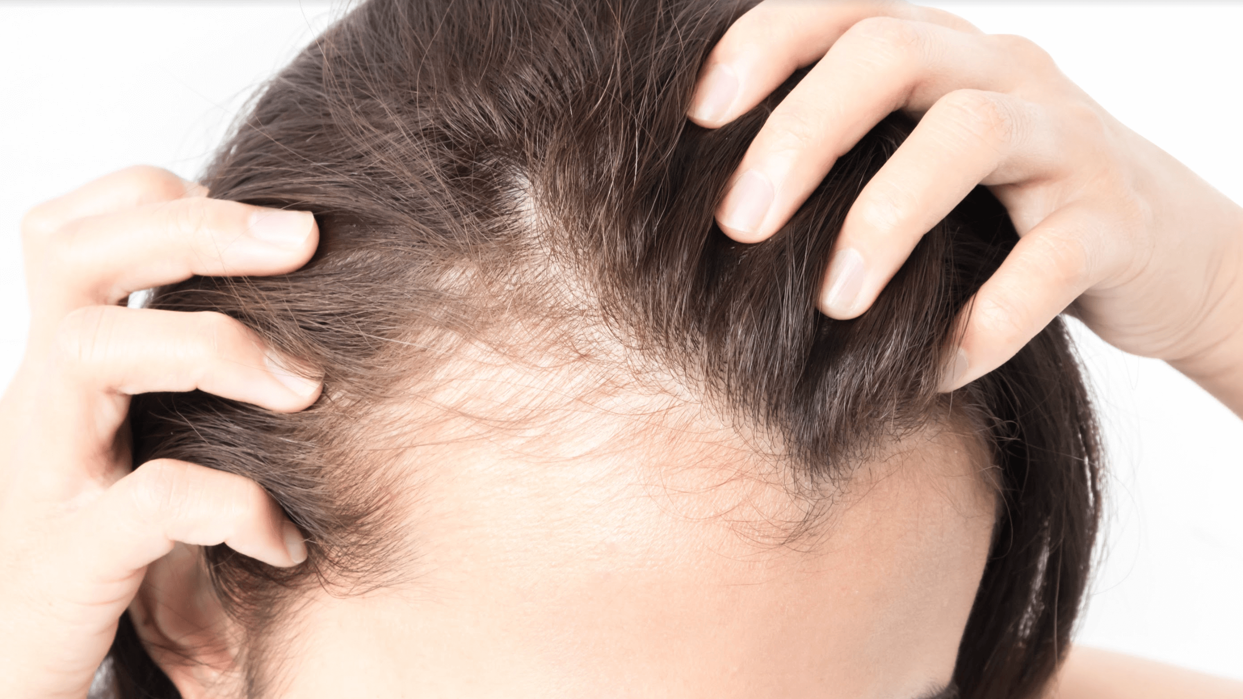 How Thick Can Hair Grow Back After a Hair Transplant?