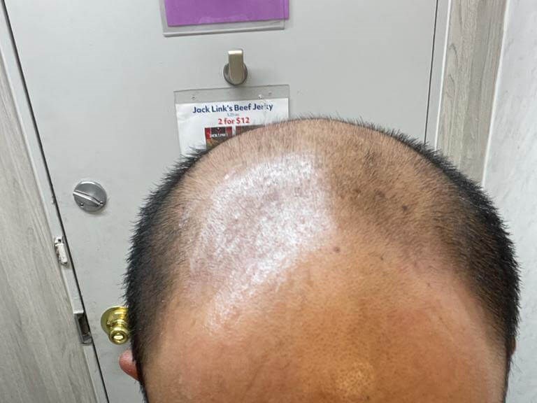 Hair Transplant Before
