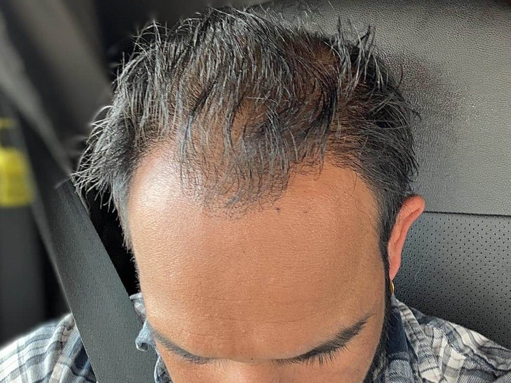 Hair Transplant After