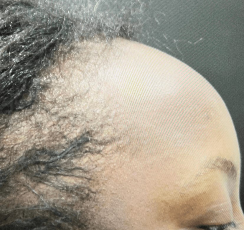 Forehead Reduction Procedure Before