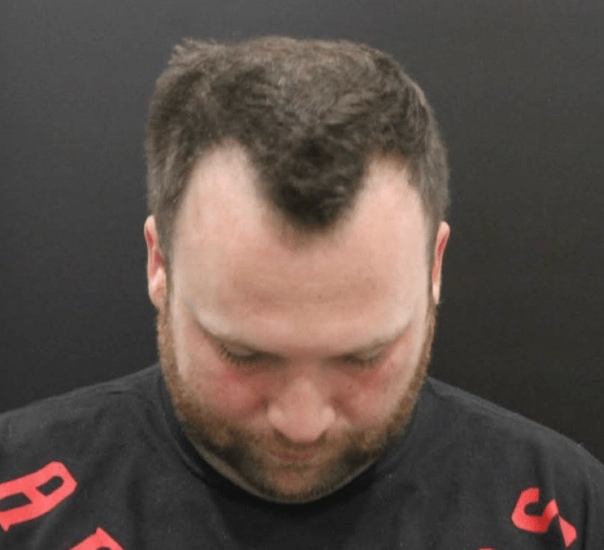 Hair Transplant Procedure Before