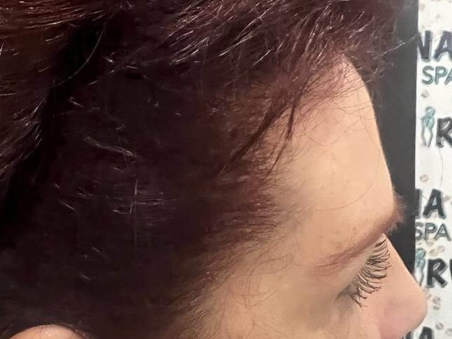 Forehead Reduction After