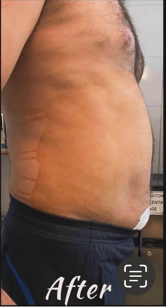 liposuction After
