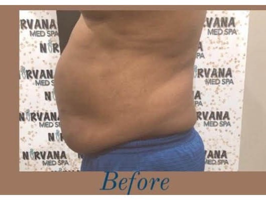 Liposuction Before