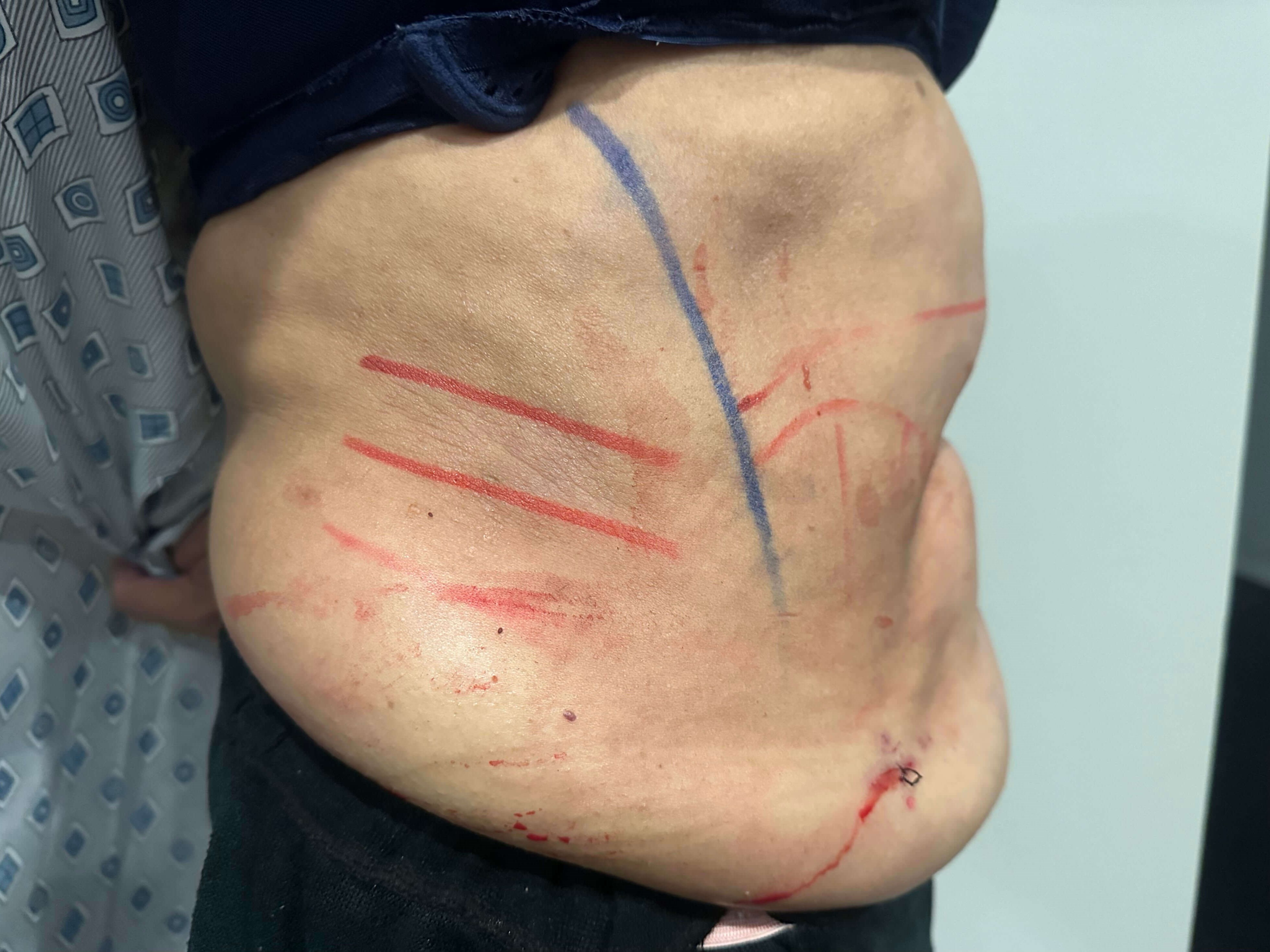 Liposuction After
