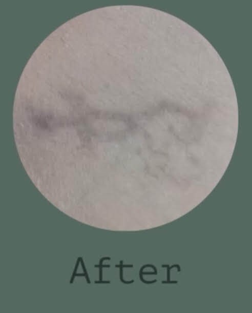 Tattoo Removal After