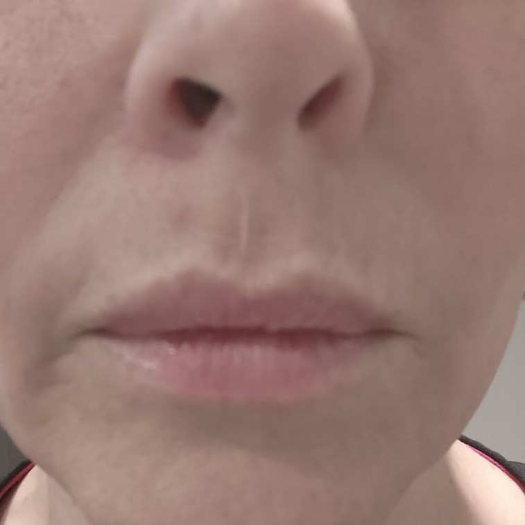 Permanent Lip Flip  BEFORE