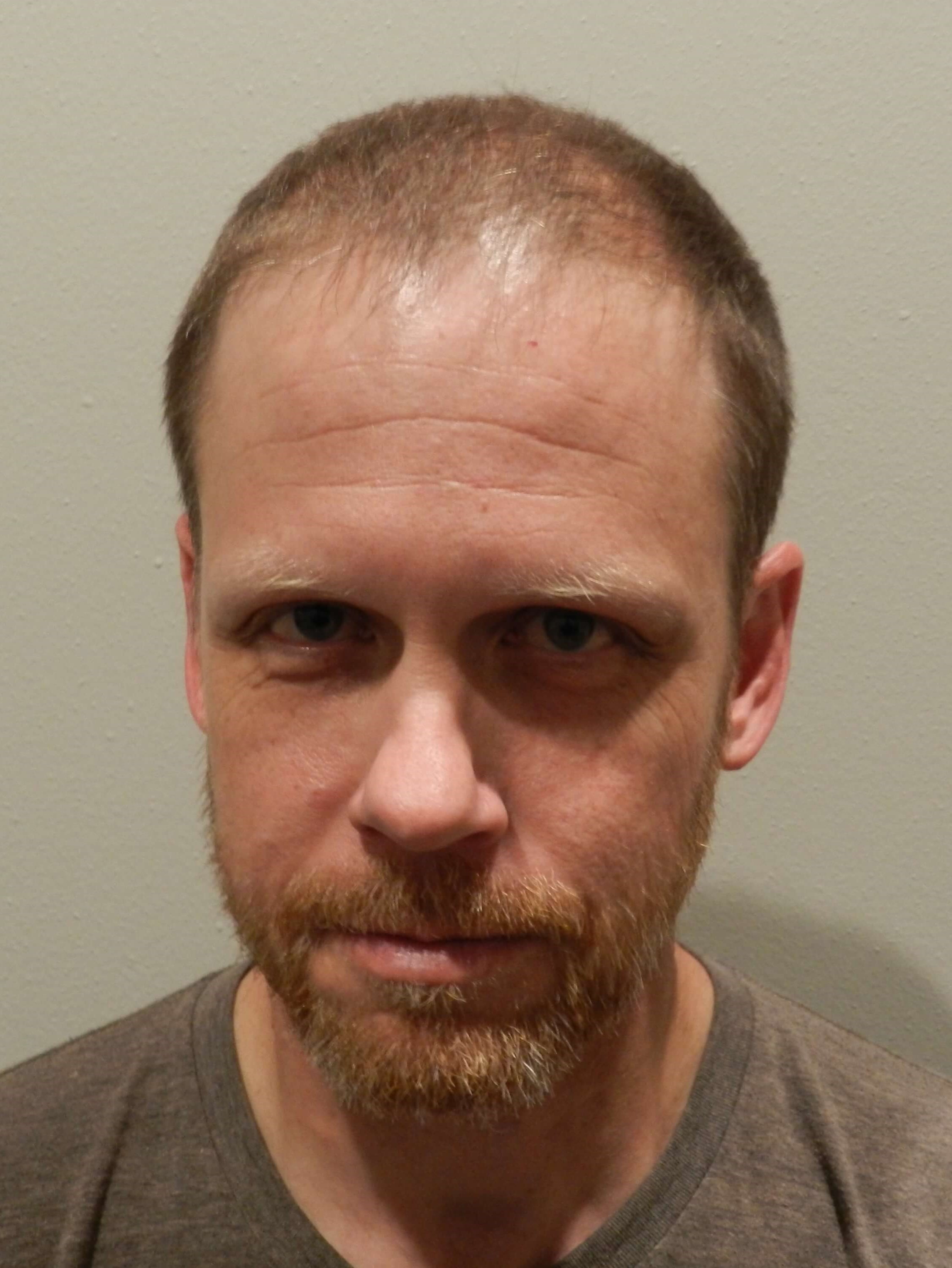 Hair Transplant Front View Before