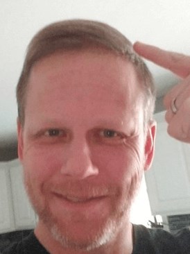 Hair Transplant Front View After