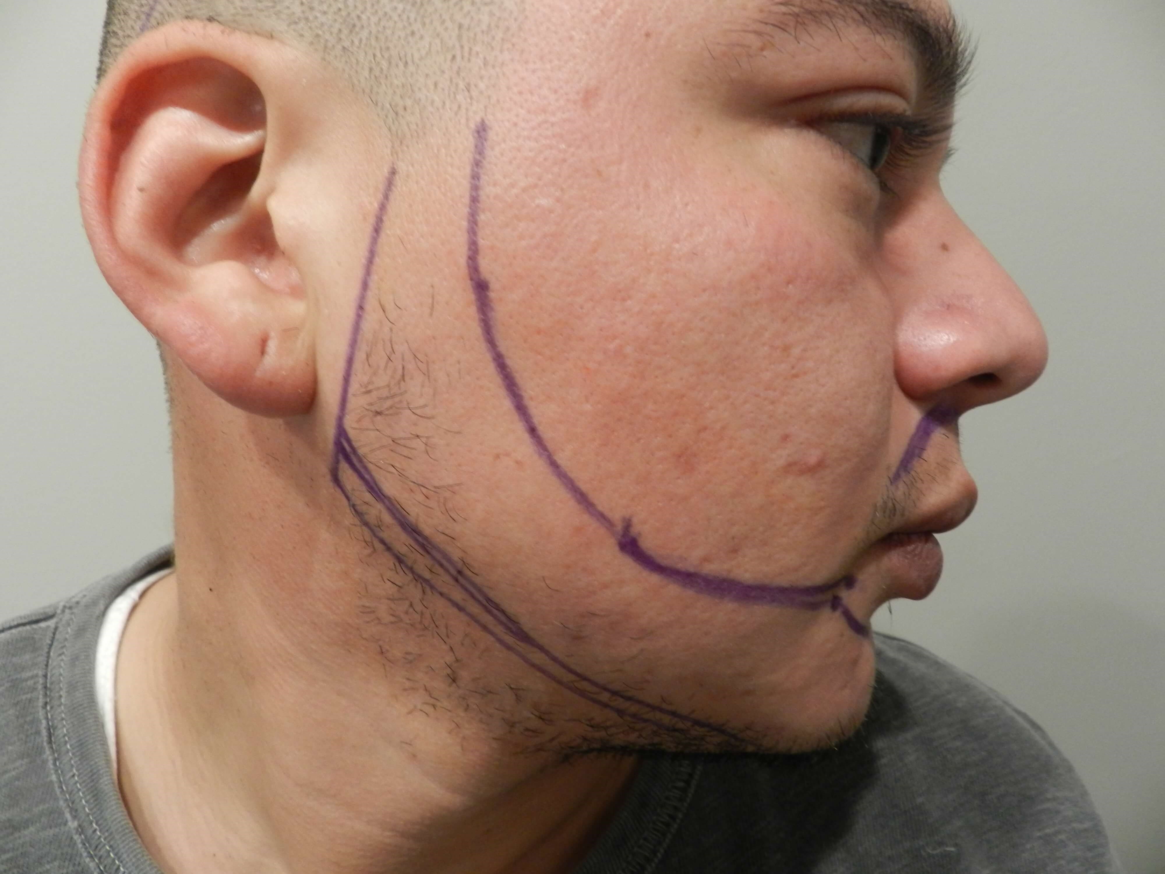 Hair Transplant Before