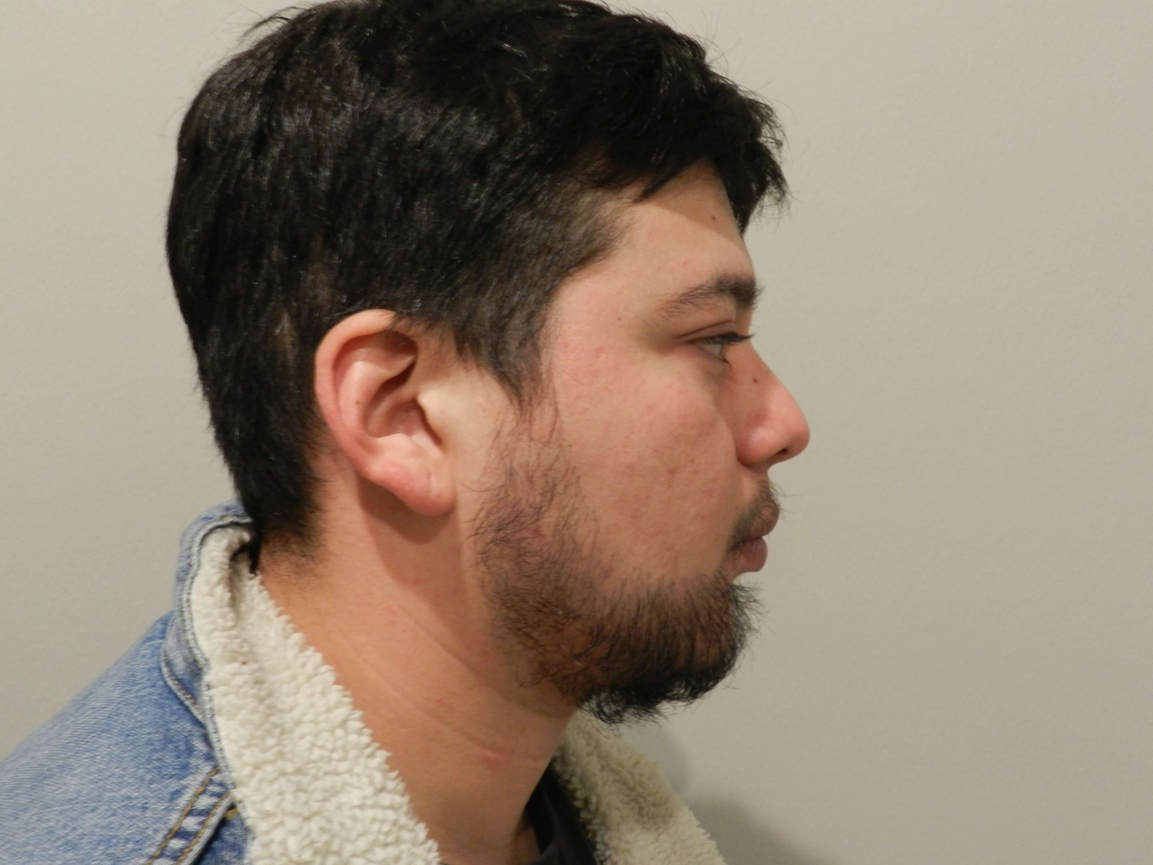 Hair Transplant After