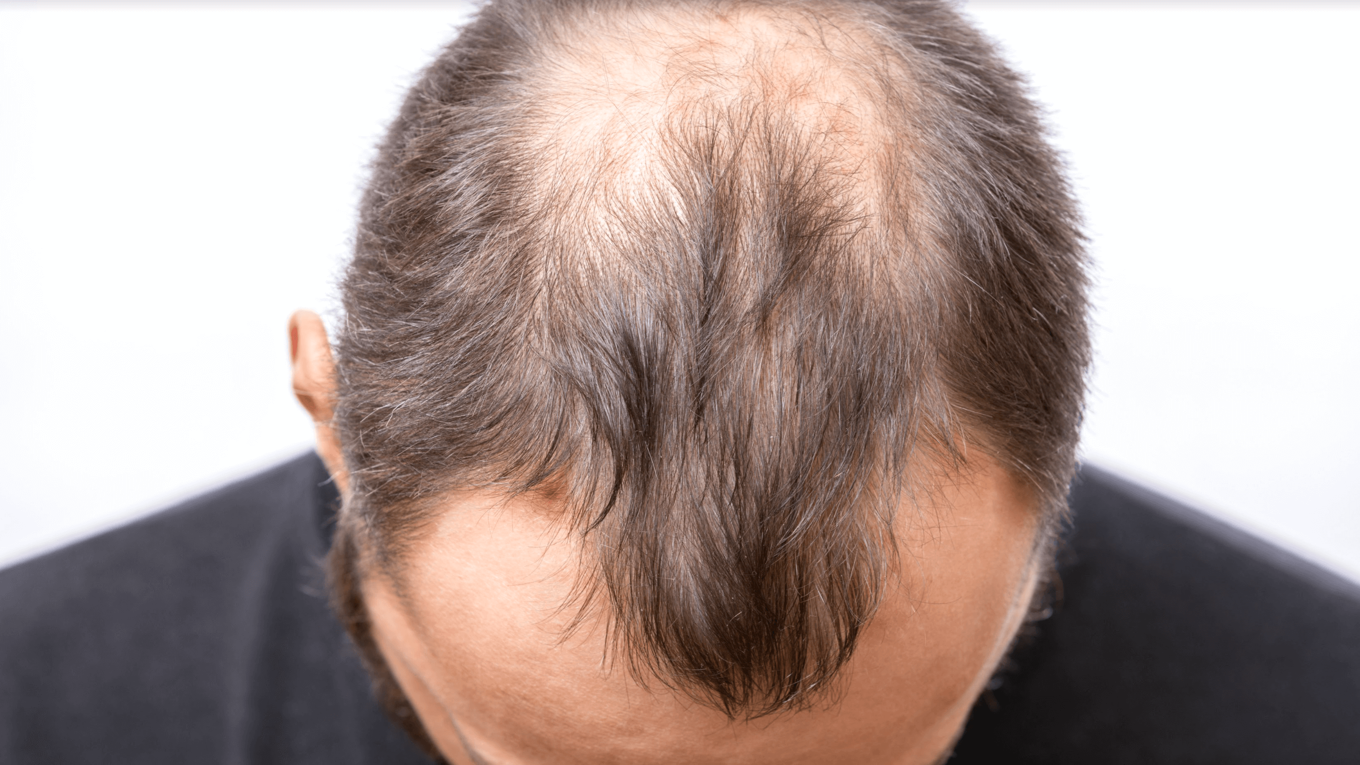 How Long Does Hair Take To Grow After A Hair Transplant?
