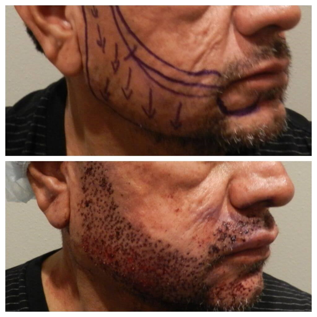beard transplant Before