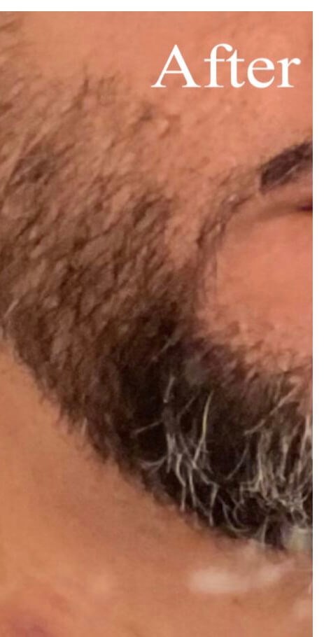 beard transplant After