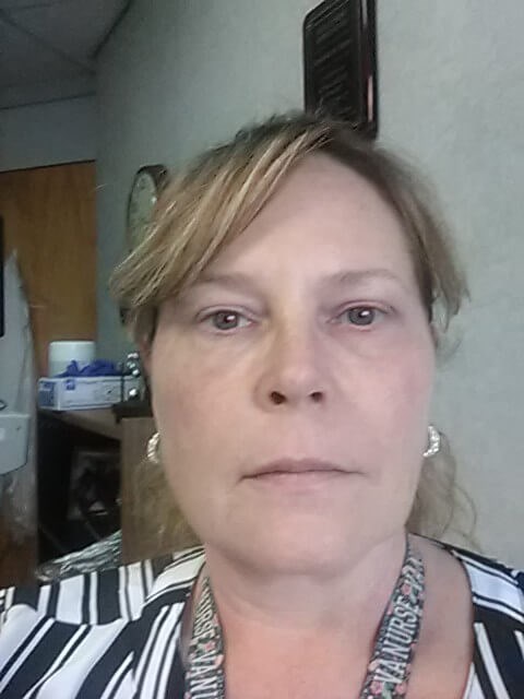 pdo thread lift and juvederm After