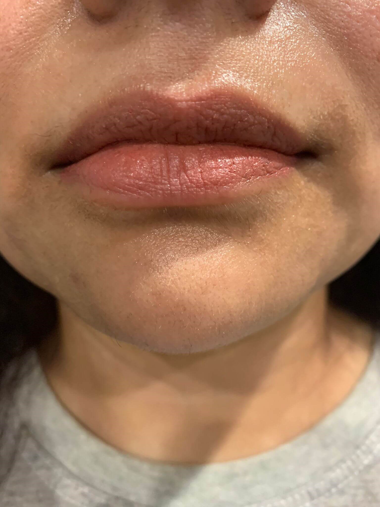 juvederm and lip flip Before