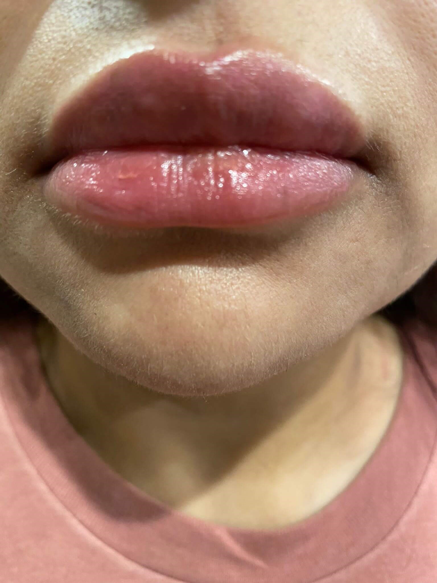 juvederm and lip flip After