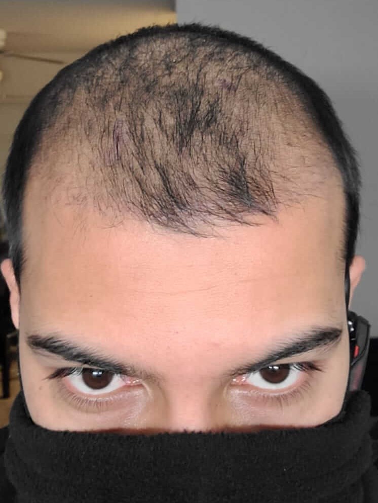 Hairtransplant Before