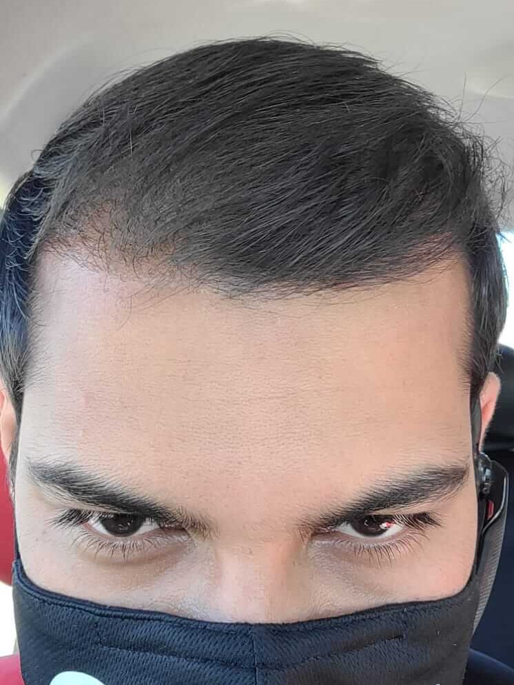 Hairtransplant After