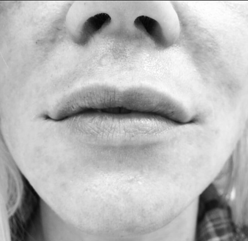 lip filler juvederm After