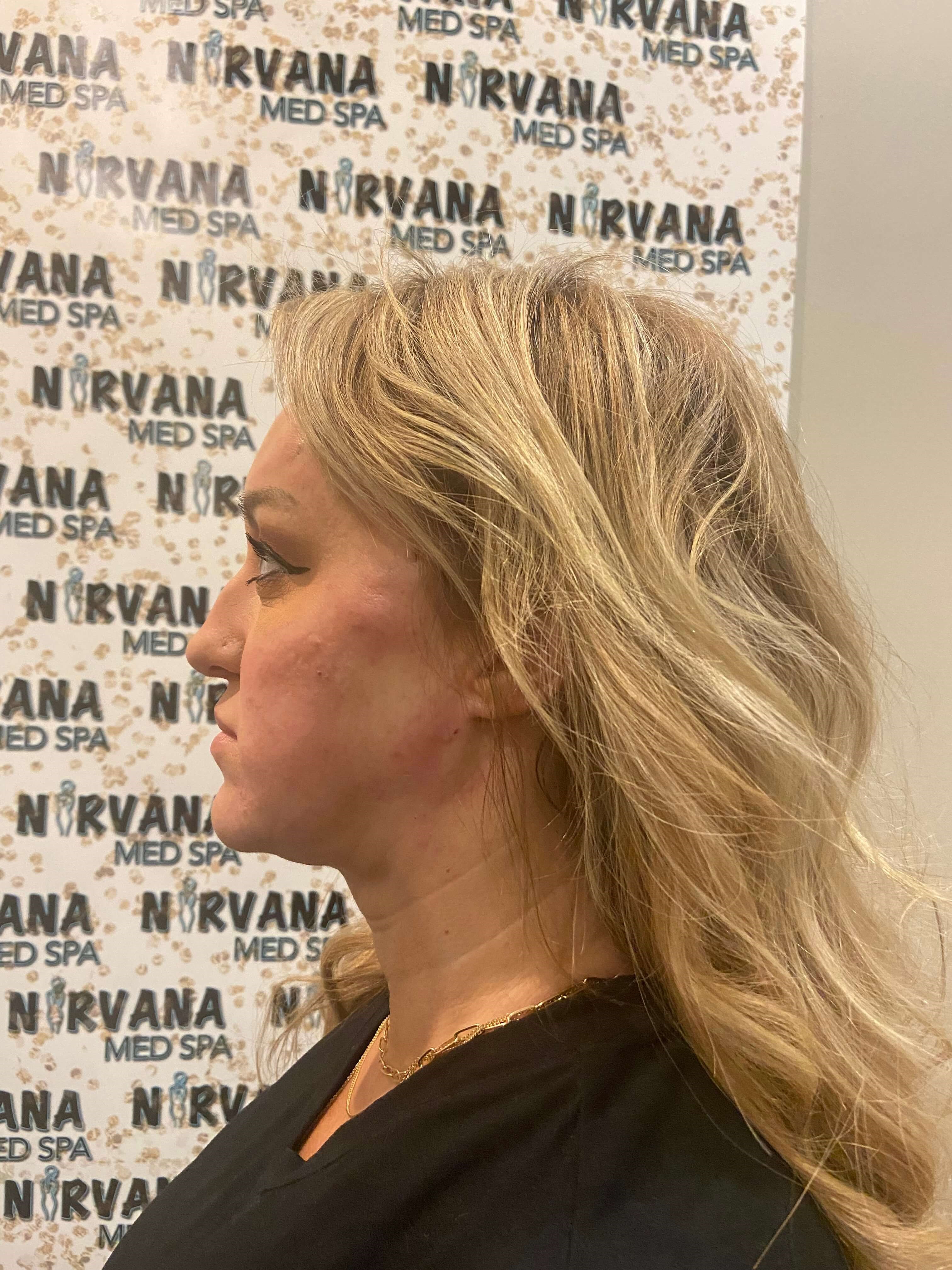 pdo brow and facelift After