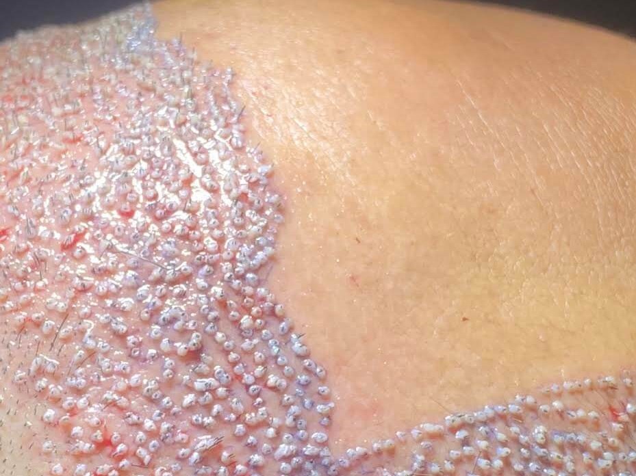 Hair Transplant After